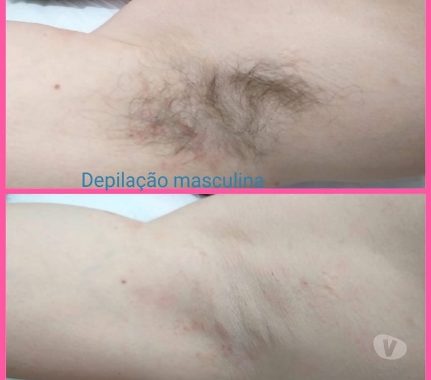 Bem-Estar - Saúde - Beleza Curitiba PR Boqueirão - Fotos para Depilação massagem Hauer