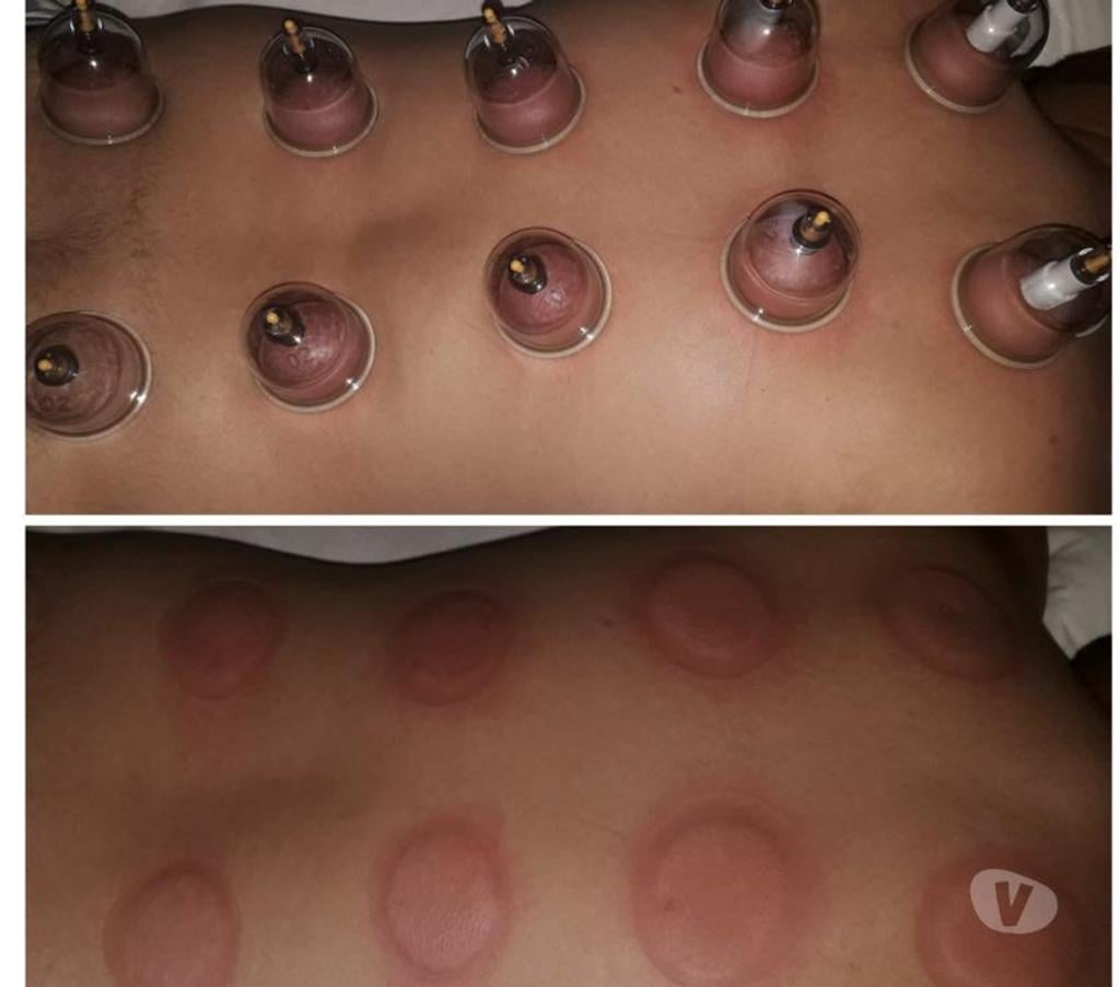 Bem-Estar - Saúde - Beleza Recife PE - Fotos para Massagens Shiatsu, Sueca,desportiva & ventosaterapia