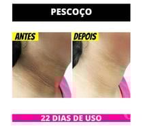 ✨Pele sem manchas com pagamento só na entrega!✨