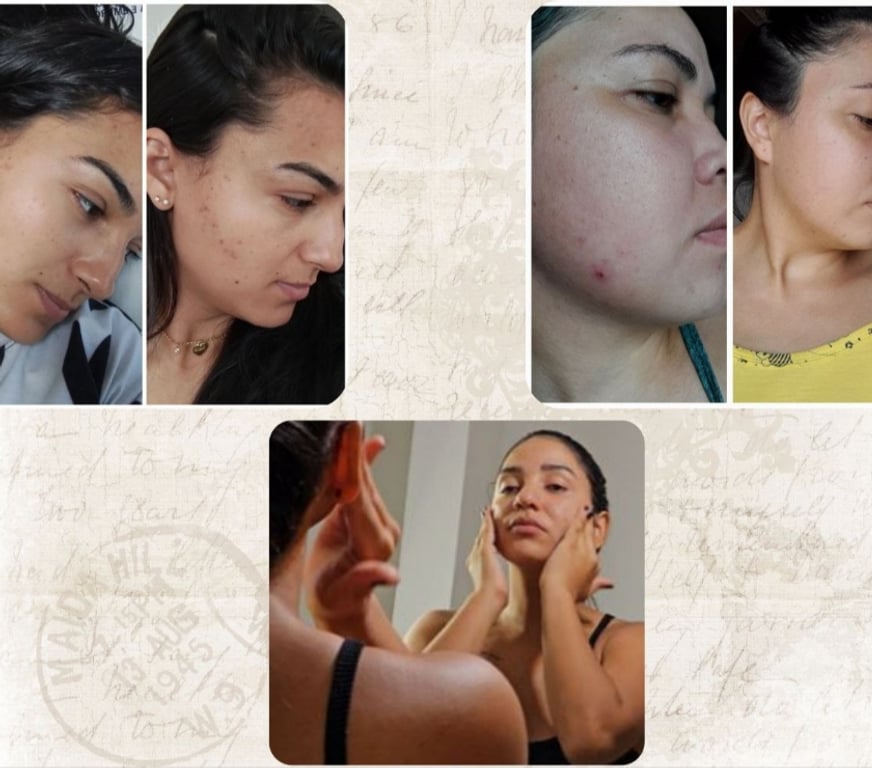 Cosméticos Sao Paulo SP Itaim Bibi - Fotos para Gel Creme Antiacne Visara