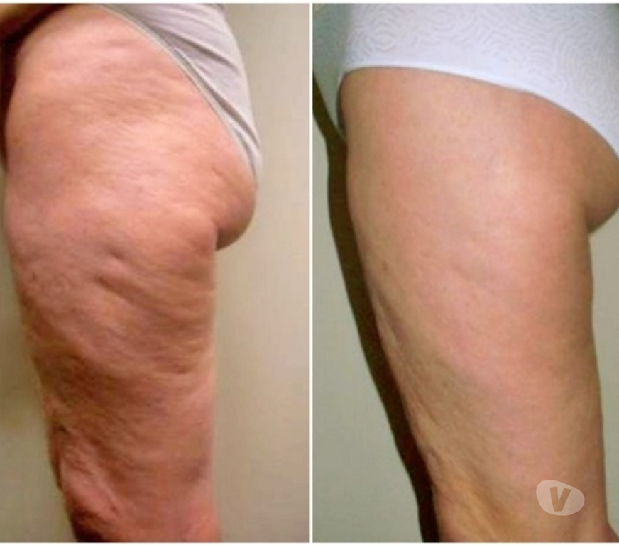 Masajes Santiago Santiago - Fotos de TONIFICACION DE GLUTEOS