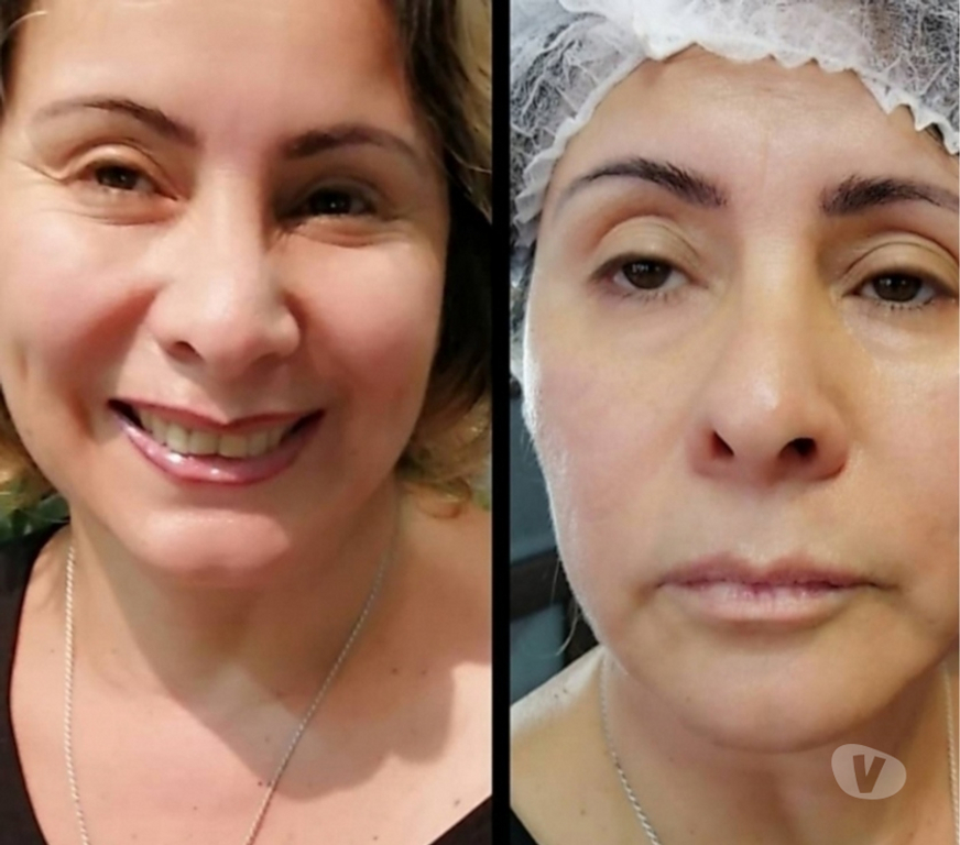 Masajes Santiago San Miguel - Fotos de Rejuvenecimiento Facial Antiage