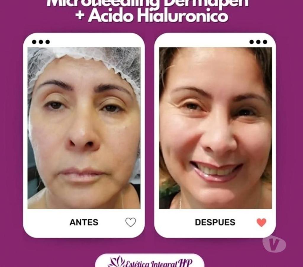 Masajes Santiago San Miguel - Fotos de Rejuvenecimiento Facial Antiage