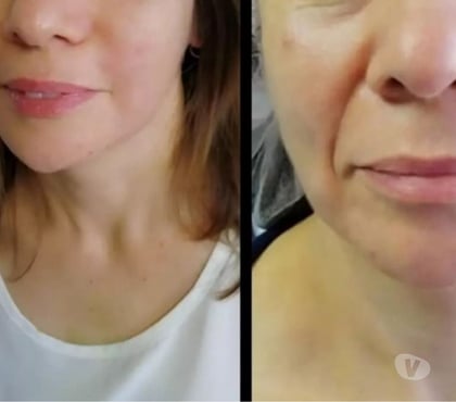  San Miguel Santiago - Fotos de Rejuvenecimiento Facial Antiage