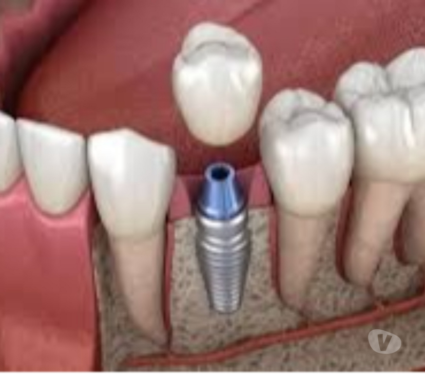 Masajes Santiago Providencia - Fotos de IMPLANTES DENTALES