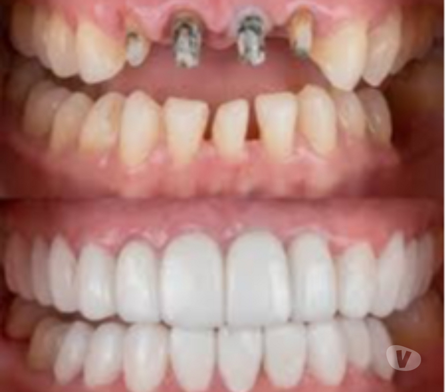 Masajes Santiago Providencia - Fotos de IMPLANTES DENTALES