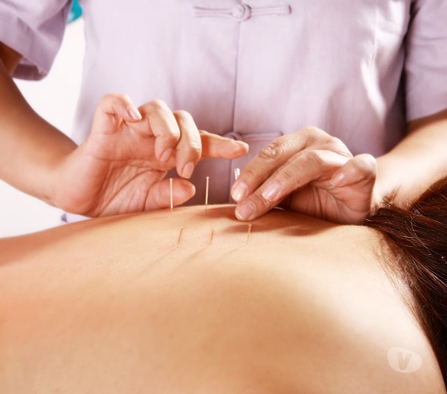 Freelance - Servicios Profesionales San Antonio San Antonio - Fotos de Acupuntura para el dolor