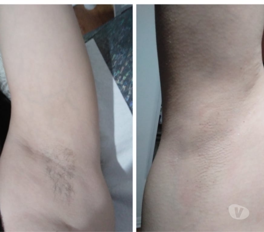 Masajes Santiago Providencia - Fotos de Depilación VIP TOBALABA