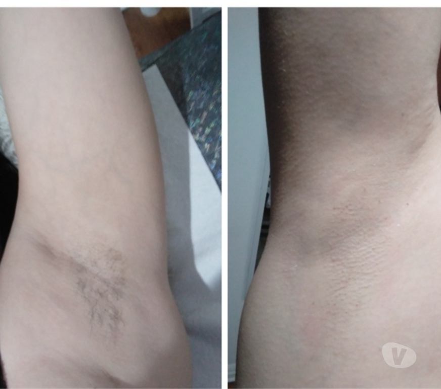 Masajes Santiago Providencia - Fotos de Depilación corporal...