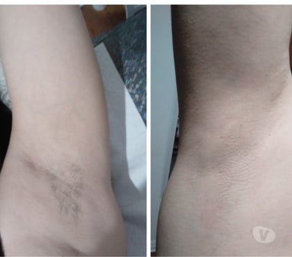 Belleza Providencia Santiago - Fotos de Depilación corporal...