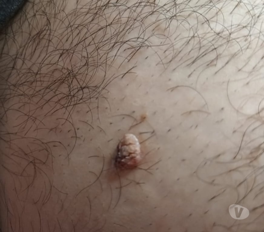 Masajes Santiago Santiago - Fotos de LESIONES CUTÁNEAS SANTIAGO CENTRO