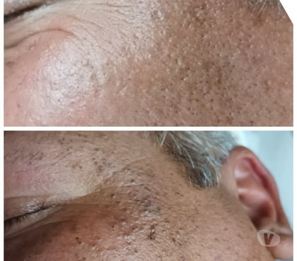  Santiago Santiago - Fotos de LESIONES CUTÁNEAS SANTIAGO CENTRO